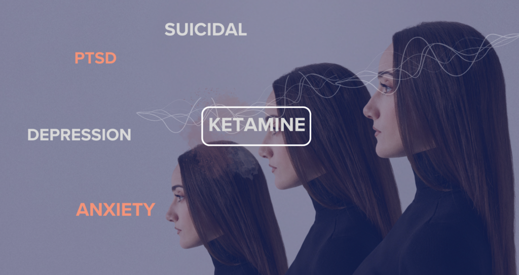 Side profile of a woman with ketamine linked to anxiety, depression, PTSD, and suicidal thoughts